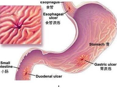 胃溃疡可以吃煮小瓜吗,胃溃疡患者适宜食用煮小瓜的饮食建议